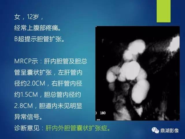 【PPT】MRCP在胆道系统疾病中的诊断价值