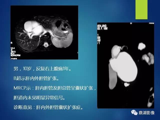【PPT】MRCP在胆道系统疾病中的诊断价值