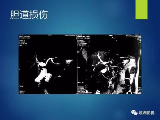 【PPT】MRCP在胆道系统疾病中的诊断价值