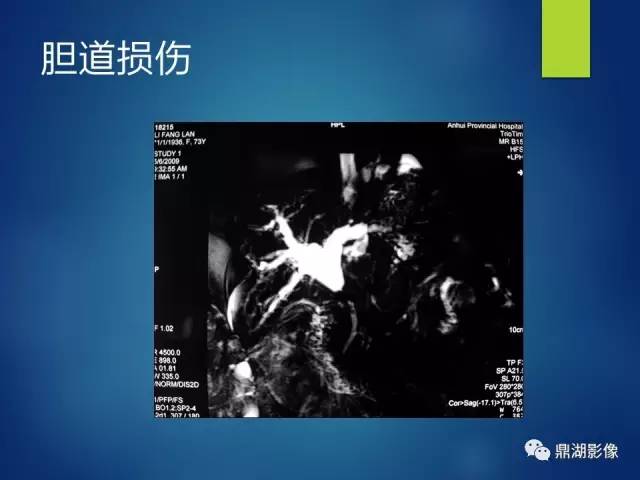 【PPT】MRCP在胆道系统疾病中的诊断价值