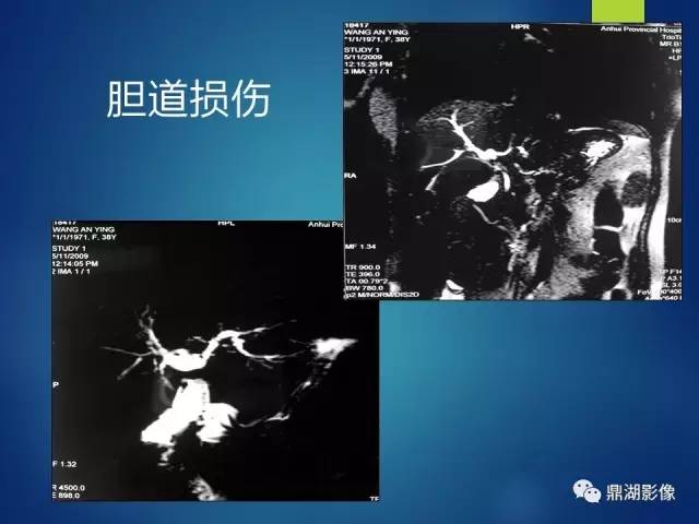 【PPT】MRCP在胆道系统疾病中的诊断价值