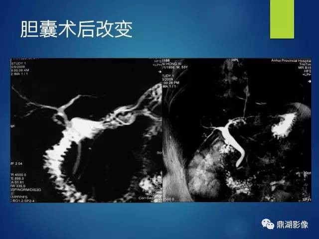 【PPT】MRCP在胆道系统疾病中的诊断价值