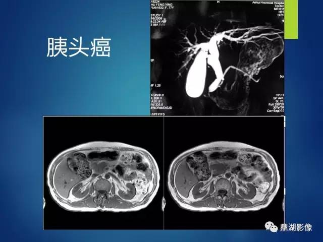 【PPT】MRCP在胆道系统疾病中的诊断价值