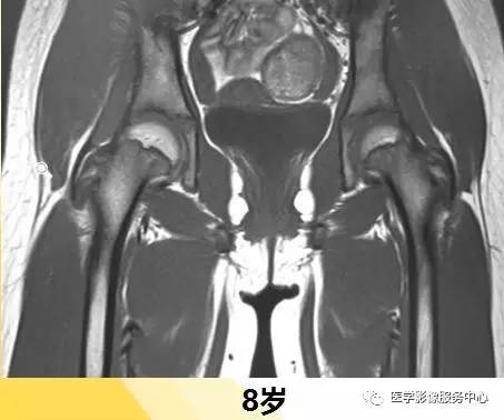 一图看懂正常股骨骨髓转换 一图看懂正常股骨骨髓转换
