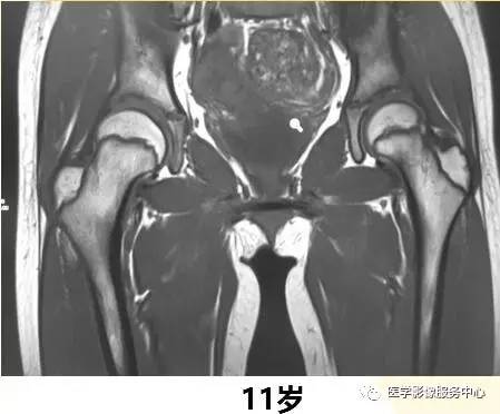 一图看懂正常股骨骨髓转换 一图看懂正常股骨骨髓转换