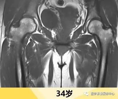 一图看懂正常股骨骨髓转换 一图看懂正常股骨骨髓转换