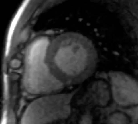 【病例】感染性心肌炎1例MR影像表现解读 【病例】感染性心肌炎1例MR影像表现解读