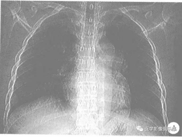【病例】肺动脉瘤1例CT影像表现