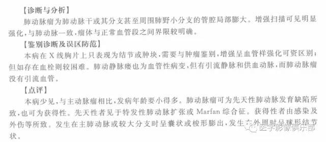 【病例】肺动脉瘤1例CT影像表现