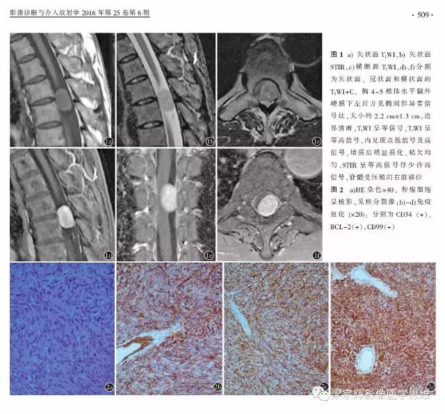 【病例】椎管内孤立性纤维瘤1例MR影像诊断思路