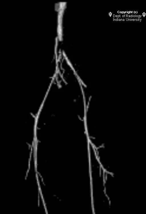 【病例】Leriche 综合征1例CT影像表现 【病例】Leriche 综合征1例CT影像表现