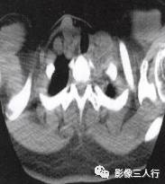 “横膈矛盾运动征” 的影像表现与临床意义 “横膈矛盾运动征” 的影像表现与临床意义