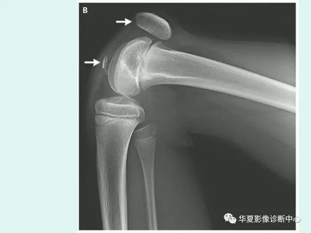 【病例】髌骨袖状撕脱骨折1例X线影像表现
