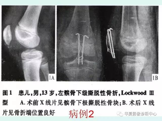 【病例】髌骨袖状撕脱骨折1例X线影像表现