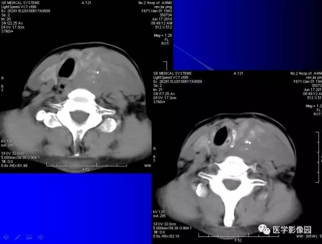 【病例】甲状腺癌1例CT影像表现 【病例】甲状腺癌1例CT影像表现