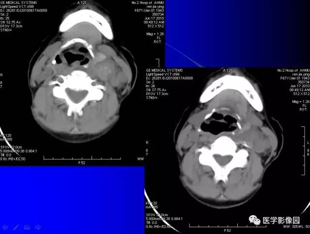 【病例】甲状腺癌1例CT影像表现 【病例】甲状腺癌1例CT影像表现