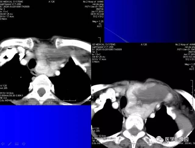 【病例】甲状腺癌1例CT影像表现 【病例】甲状腺癌1例CT影像表现