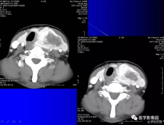 【病例】甲状腺癌1例CT影像表现 【病例】甲状腺癌1例CT影像表现
