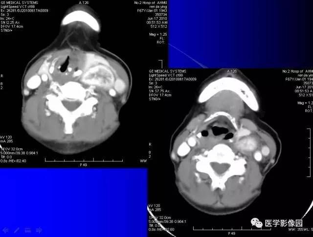 【病例】甲状腺癌1例CT影像表现 【病例】甲状腺癌1例CT影像表现