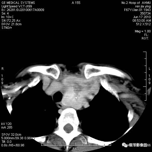 【病例】甲状腺癌1例CT影像表现 【病例】甲状腺癌1例CT影像表现