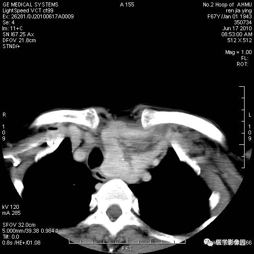 【病例】甲状腺癌1例CT影像表现 【病例】甲状腺癌1例CT影像表现
