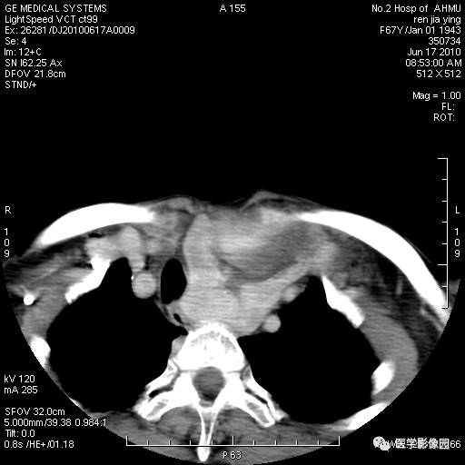【病例】甲状腺癌1例CT影像表现 【病例】甲状腺癌1例CT影像表现