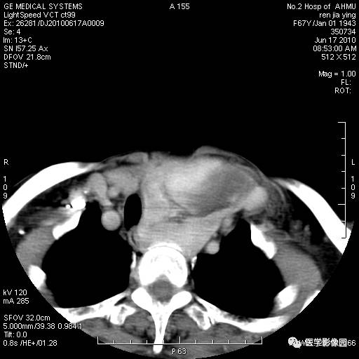 【病例】甲状腺癌1例CT影像表现 【病例】甲状腺癌1例CT影像表现