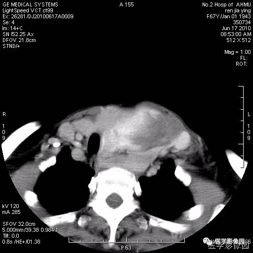 【病例】甲状腺癌1例CT影像表现 【病例】甲状腺癌1例CT影像表现