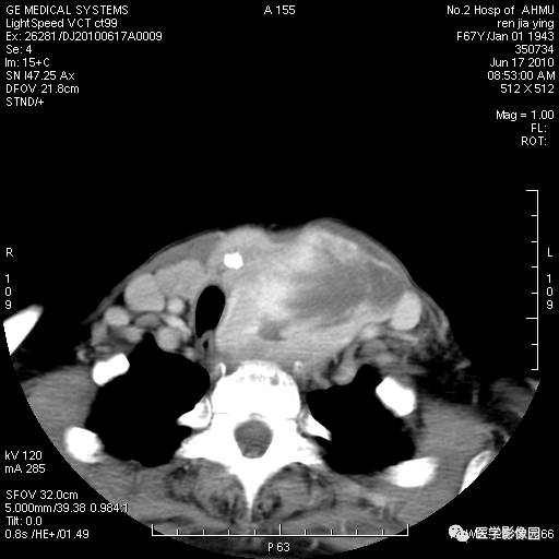 【病例】甲状腺癌1例CT影像表现 【病例】甲状腺癌1例CT影像表现