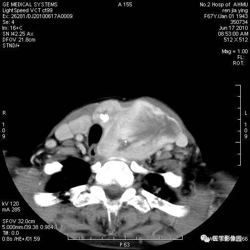 【病例】甲状腺癌1例CT影像表现 【病例】甲状腺癌1例CT影像表现