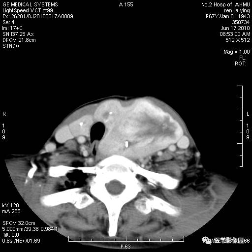 【病例】甲状腺癌1例CT影像表现 【病例】甲状腺癌1例CT影像表现