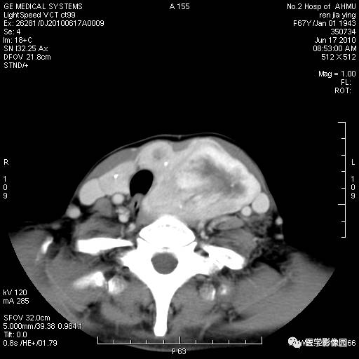 【病例】甲状腺癌1例CT影像表现 【病例】甲状腺癌1例CT影像表现
