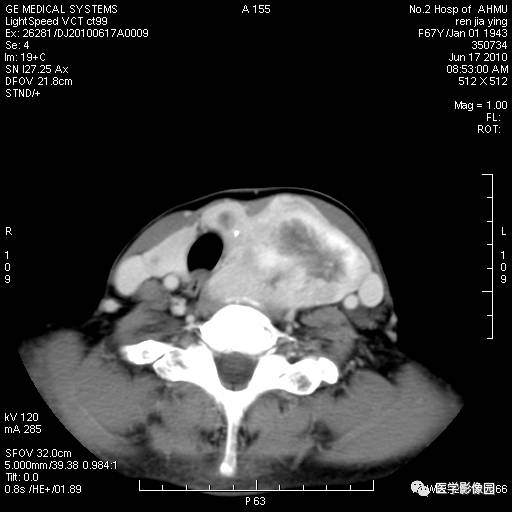【病例】甲状腺癌1例CT影像表现 【病例】甲状腺癌1例CT影像表现