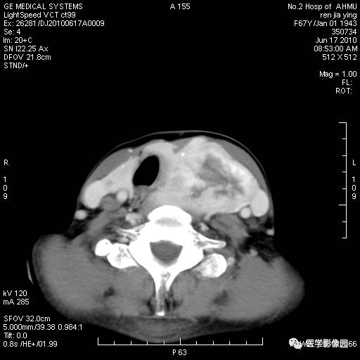 【病例】甲状腺癌1例CT影像表现 【病例】甲状腺癌1例CT影像表现