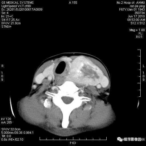 【病例】甲状腺癌1例CT影像表现 【病例】甲状腺癌1例CT影像表现