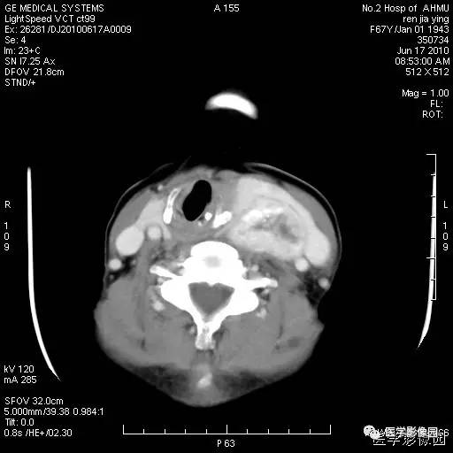 【病例】甲状腺癌1例CT影像表现 【病例】甲状腺癌1例CT影像表现