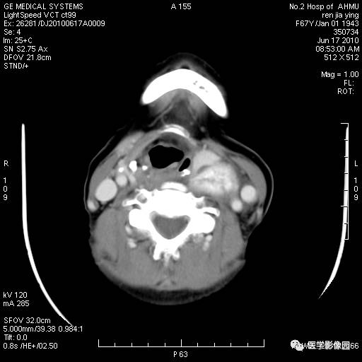 【病例】甲状腺癌1例CT影像表现 【病例】甲状腺癌1例CT影像表现