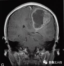 【病例】左额叶胶质母细胞瘤1例MR影像表现分析