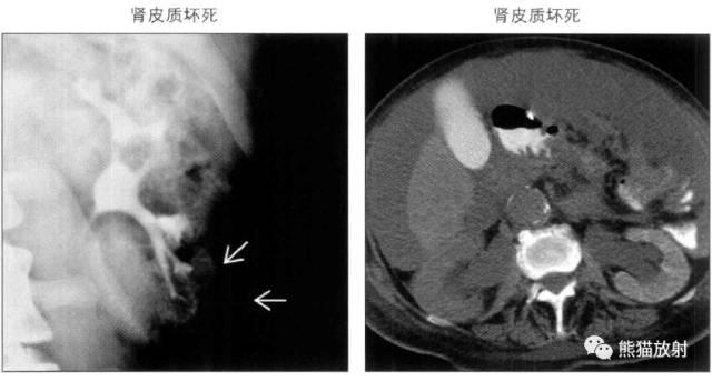 “肾皮/髓质钙质沉着症”的鉴别诊断