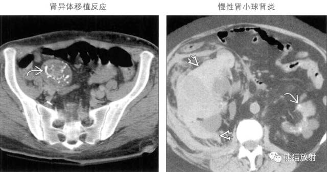 “肾皮/髓质钙质沉着症”的鉴别诊断