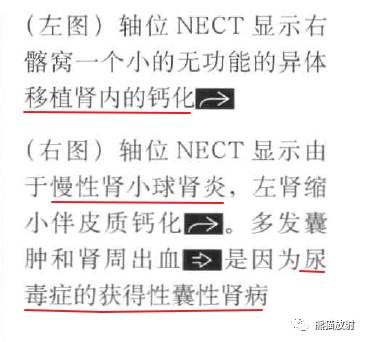 “肾皮/髓质钙质沉着症”的鉴别诊断