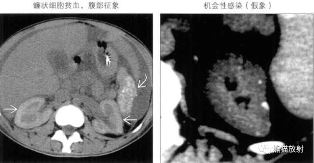 “肾皮/髓质钙质沉着症”的鉴别诊断