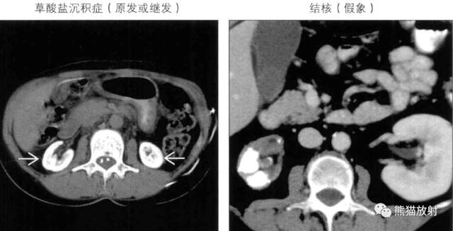 “肾皮/髓质钙质沉着症”的鉴别诊断