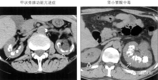 “肾皮/髓质钙质沉着症”的鉴别诊断