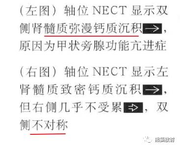 “肾皮/髓质钙质沉着症”的鉴别诊断