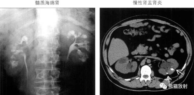 “肾皮/髓质钙质沉着症”的鉴别诊断