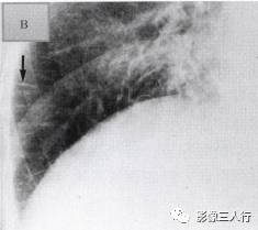 “克氏线征” 的影像表现与临床意义 “克氏线征” 的影像表现与临床意义