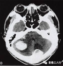 【病例】小脑多发性血管母细胞瘤1例MR影像表现分析 【病例】小脑多发性血管母细胞瘤1例MR影像表现分析