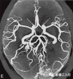 【病例】小脑多发性血管母细胞瘤1例MR影像表现分析 【病例】小脑多发性血管母细胞瘤1例MR影像表现分析