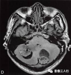【病例】小脑多发性血管母细胞瘤1例MR影像表现分析 【病例】小脑多发性血管母细胞瘤1例MR影像表现分析